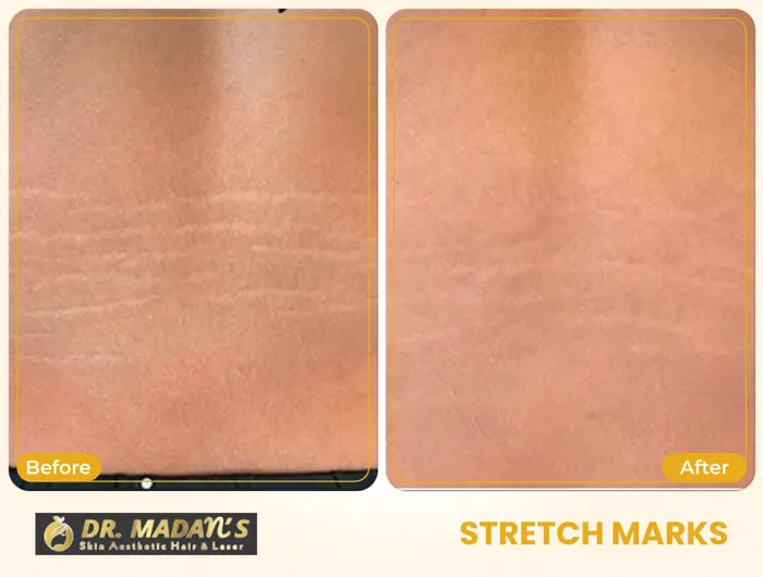 Stretch marks before and after result 4 at Dr Madan Aesthetics